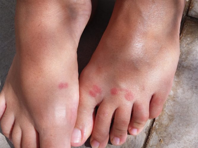 mosquito bites.