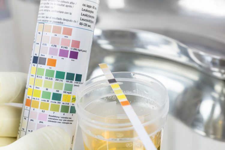 Routine test, urine rapid test, urine test strip, urine sample