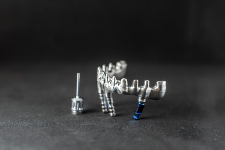 Metal frame for dental implants