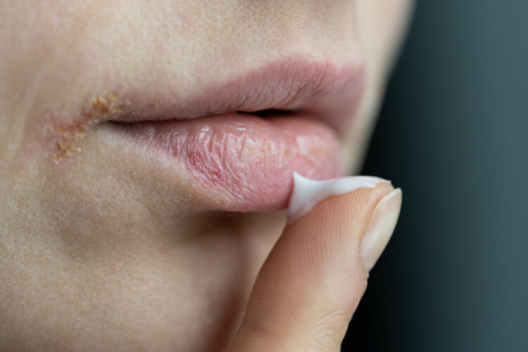 Closeup of woman applying lip balm with finger to prevent dryness and chapping in cold season