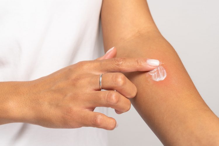 Female applying cream on swell skin after insect bites, isolated on grey studio background. Allergy.