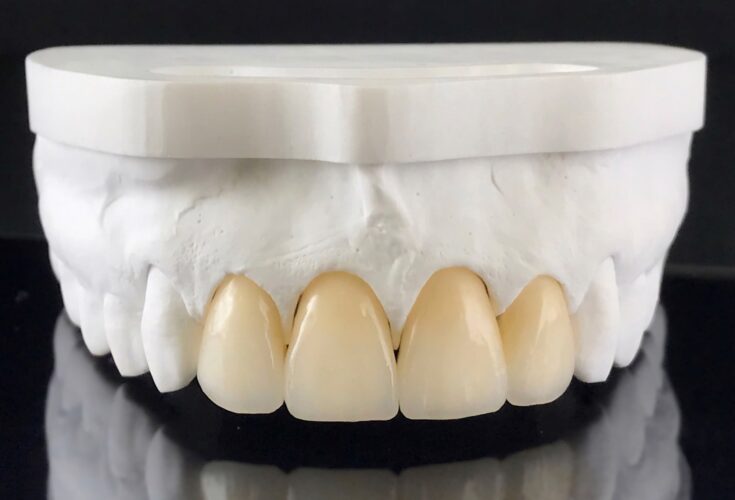 Zirconia crowns with full porcelain in the plaster model for dental treatment.