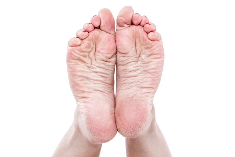 dry dehydrated skin on the heels of female feet with calluses